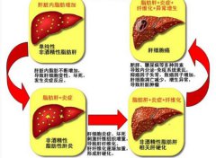 从脂肪肝到肝癌只需四步