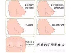 乳腺癌的早期症状表现
